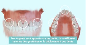 Traitement orthodontique par gouttières transparentes - Version taquets